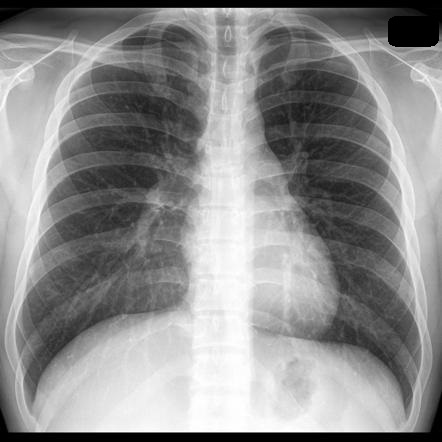 Chest Xray